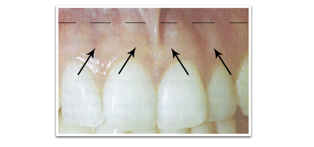 healthy gingival