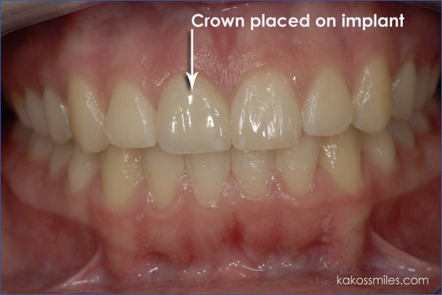 Porcelain crown placed on implant. Arlington Heights Dental Office.