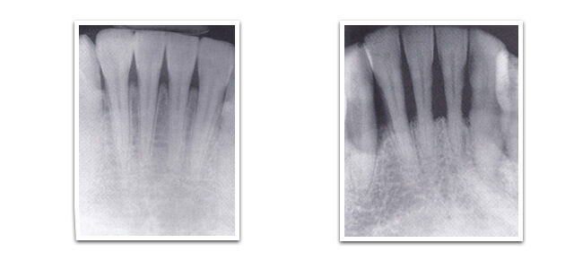 dental boneloss x-ray