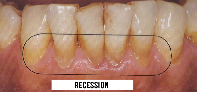 dental recession