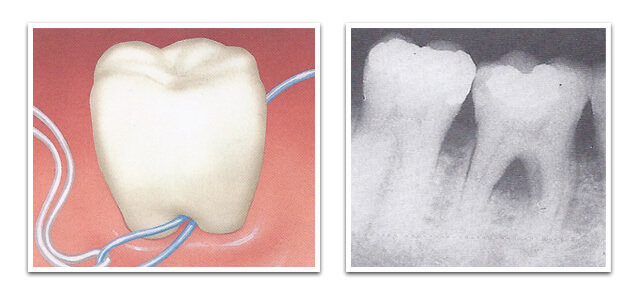 furcation