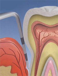 probe in a periodontal pocket