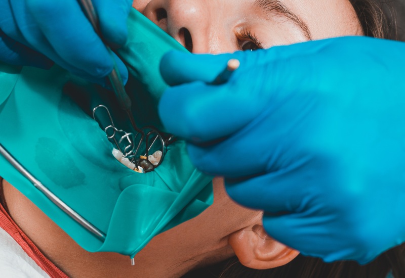 Close-up of a dentist performing a root canal procedure in Arlington Heights, IL.