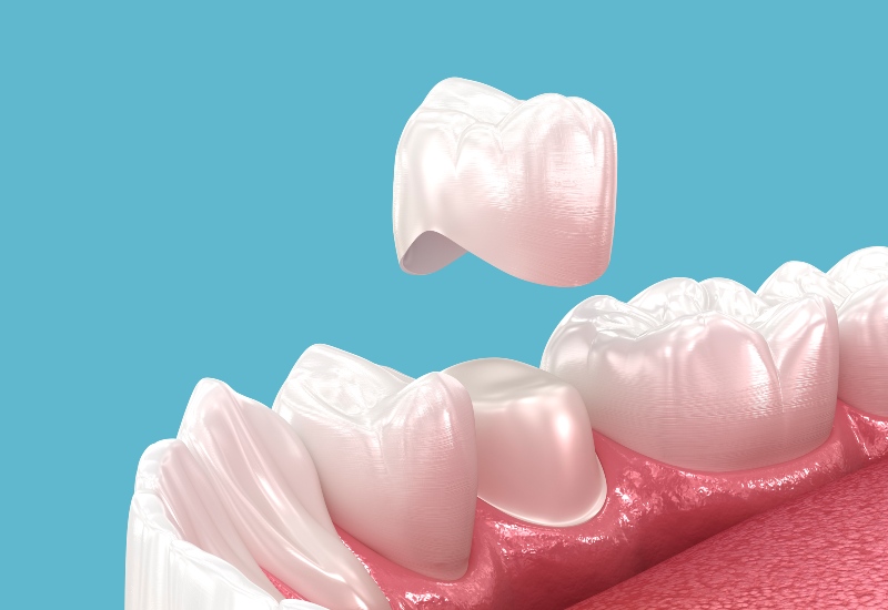 3d-illustration of dental crown by James Kakos DDS in Arlington Heights, IL