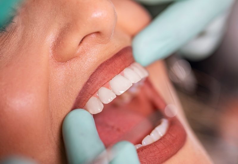 Close-up of gum health checkup in Antioch, IL showing teeth