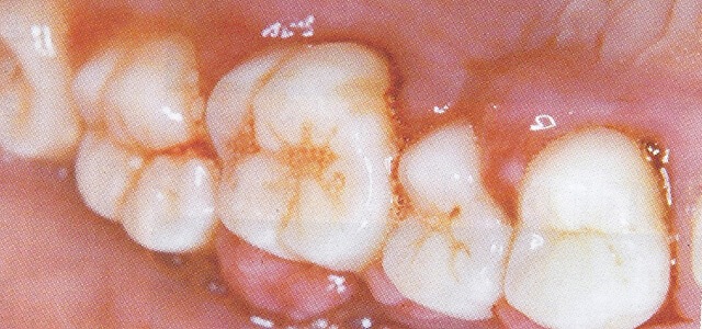 bleeding teeth