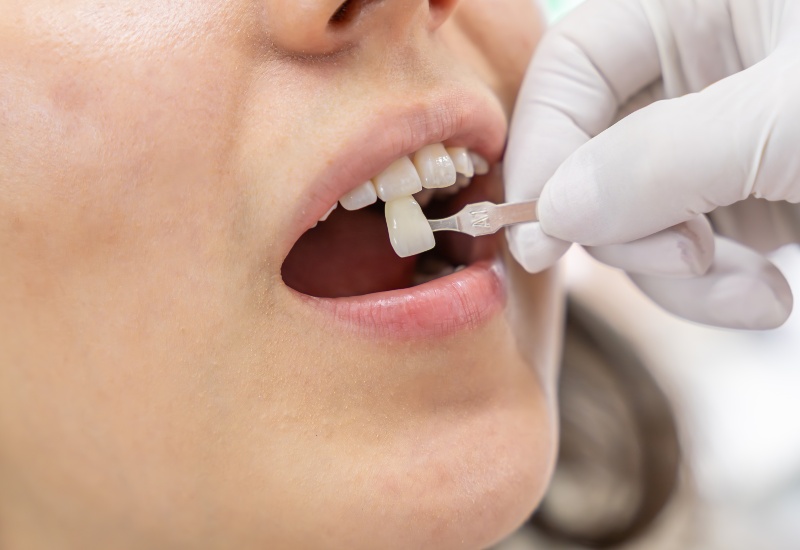 Lumineers fitting at James Kakos DDS in Arlington Heights, IL